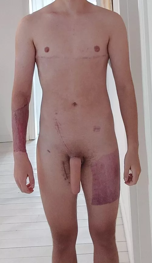 Learning to love my body with all of its scars (M,19,53kg,166cm)