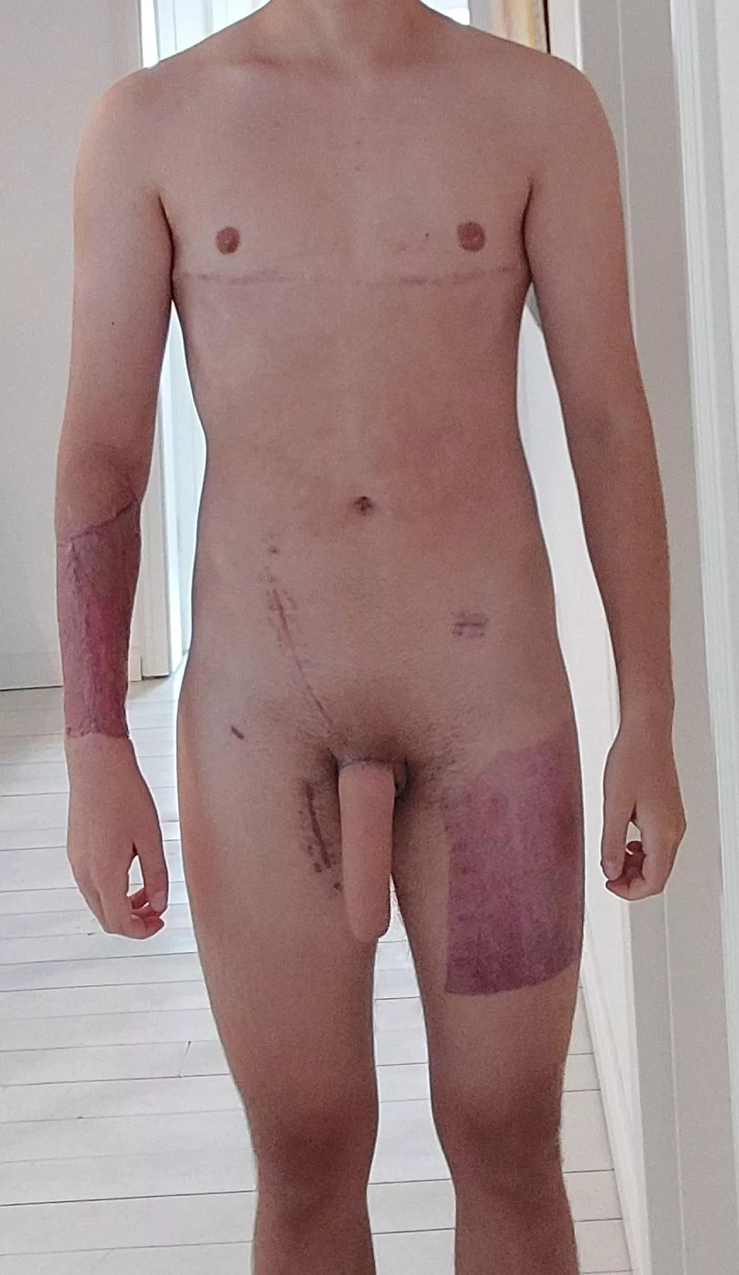 Learning to love my body with all of its scars (M,19,53kg,166cm)