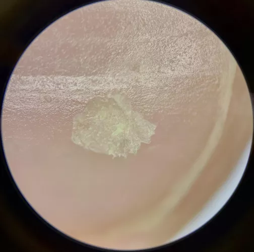 Microscopic view of plug on underside of skin flake
