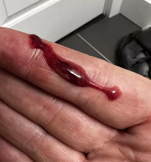 Contents of Bartholin cyst rupture 9/10 Satisfied