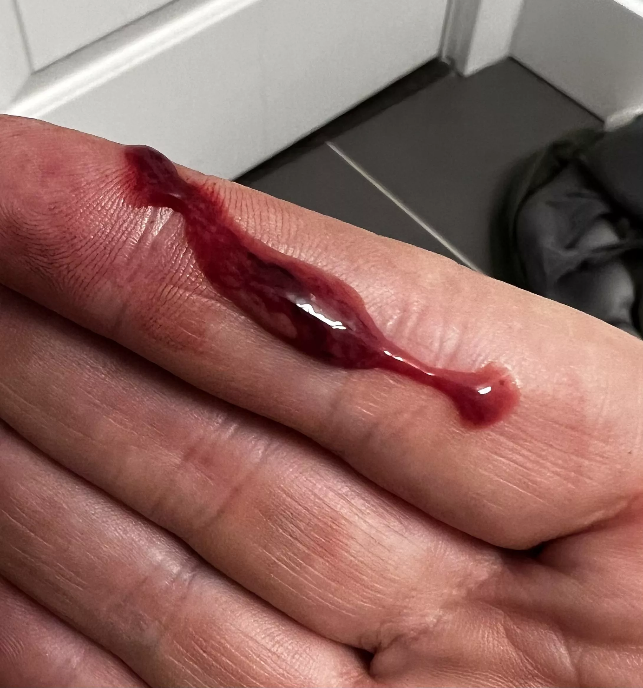 Contents of Bartholin cyst rupture 9/10 Satisfied