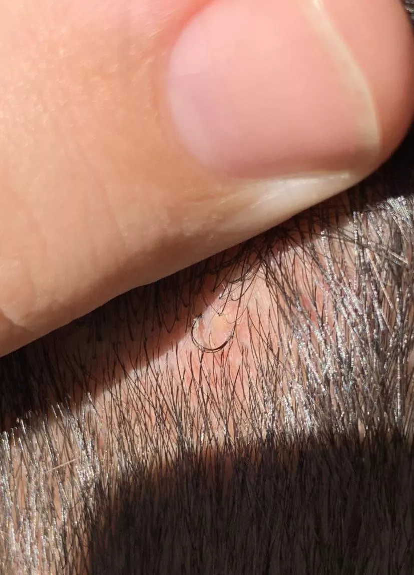Deep ingrown loop on husband’s head