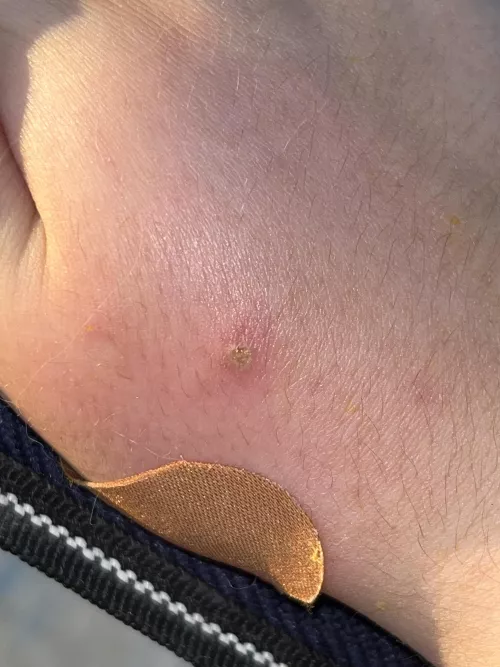 forbidden pop on the back of the hand (infected cat bite)