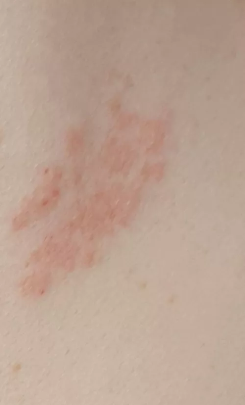 Forbidden pops- shingles