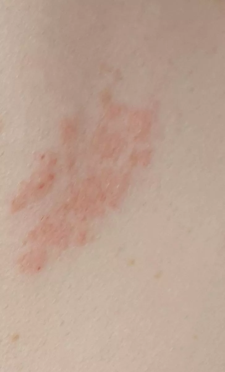 Forbidden pops- shingles