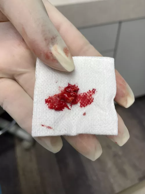 A part of the cyst that ate away the bone near my nose. Endodontist let me grab this pic