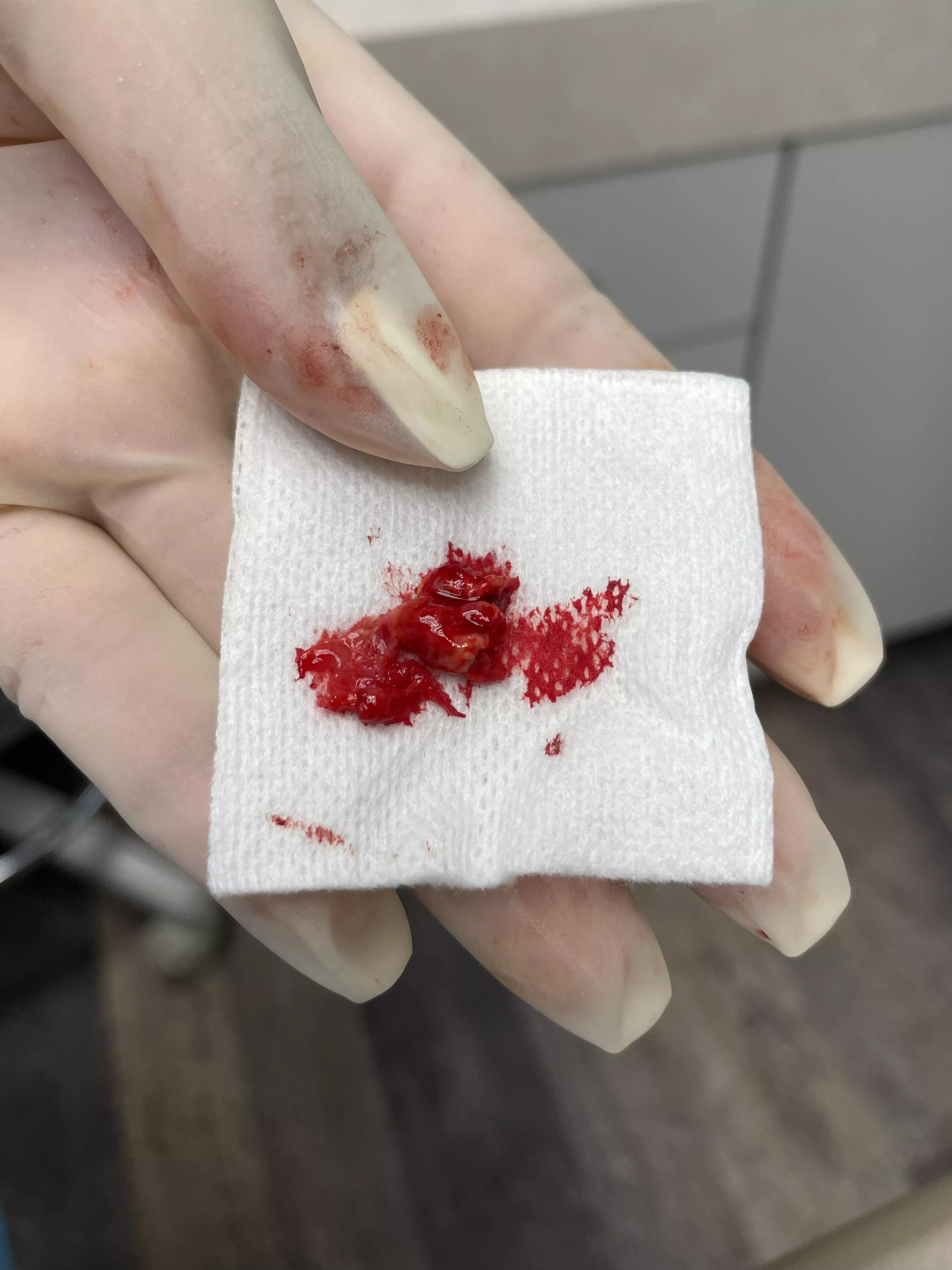 A part of the cyst that ate away the bone near my nose. Endodontist let me grab this pic