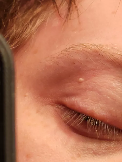 I've had this thing on my eyelid for at least 2 years now, I've tried lancing it with a sewing needle but the skin is too soft/flexible. Looking for suggestions on how to get rid of it.