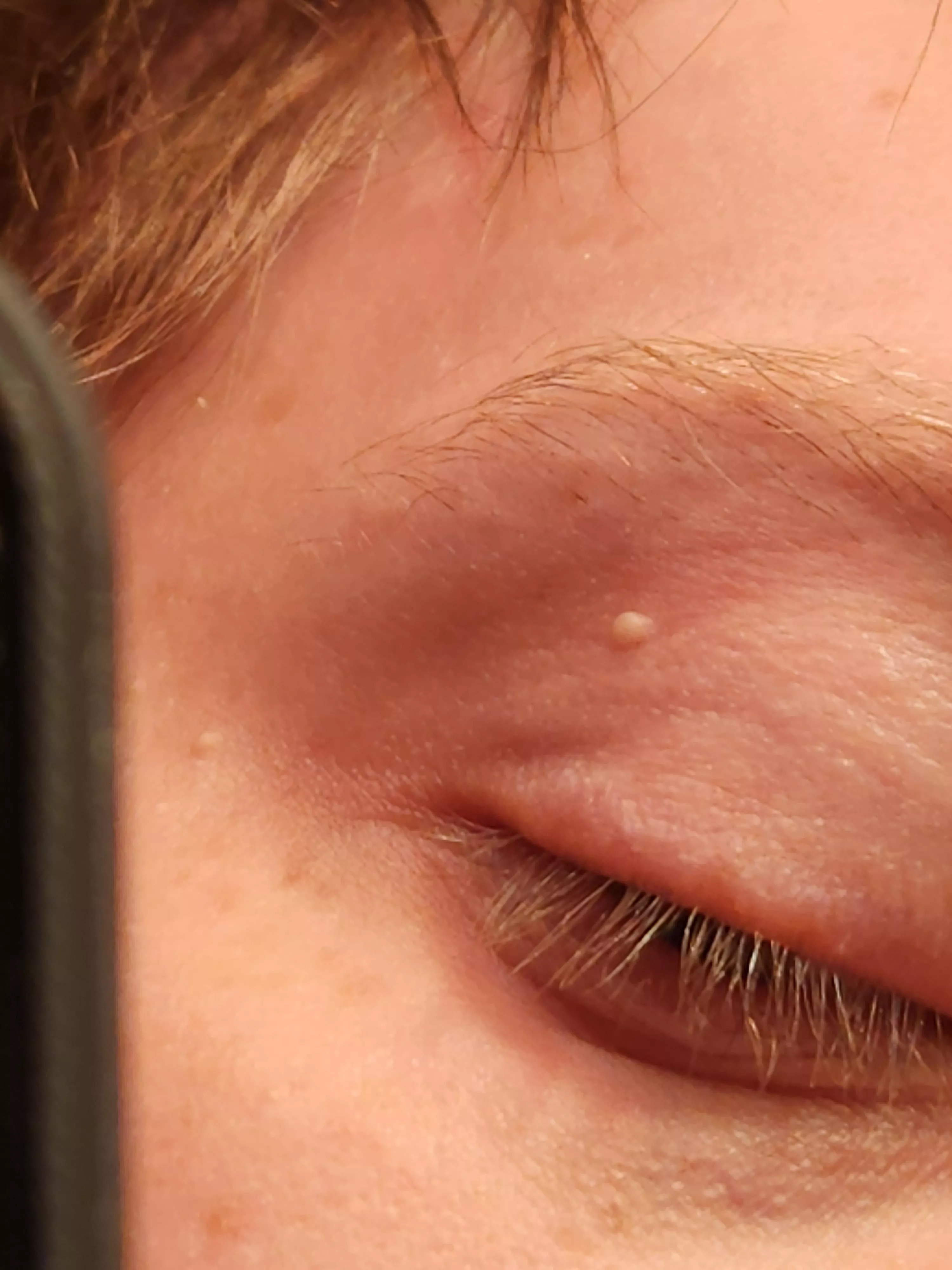 I've had this thing on my eyelid for at least 2 years now, I've tried lancing it with a sewing needle but the skin is too soft/flexible. Looking for suggestions on how to get rid of it.