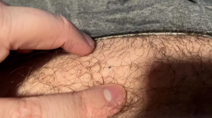 I have a small DPOW right on my waist line. Don’t worry, I ordered a comedome extractor to share with you all.