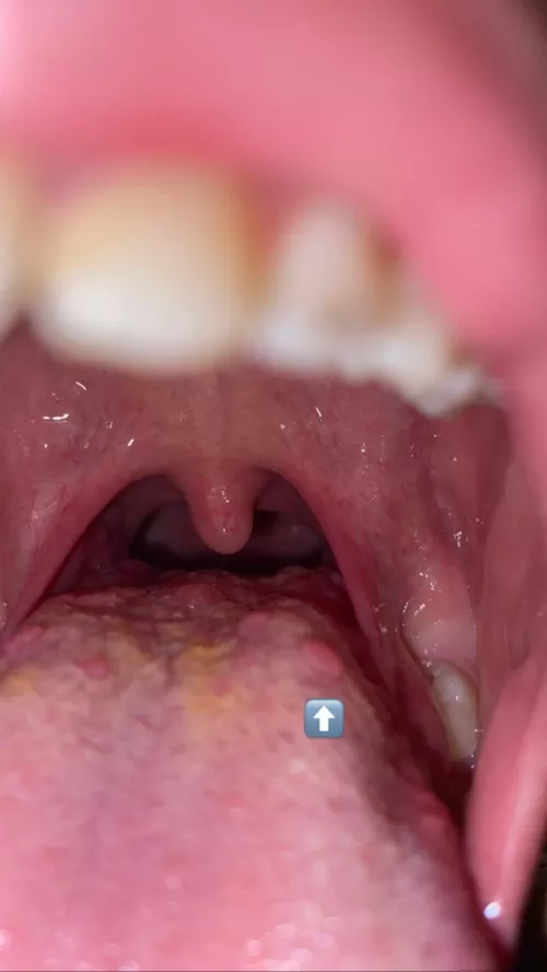 Should i try to pop or any idea what these are? (i just ate pizza so sorry for the yellowish tongue lol)