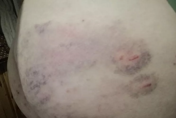 Took my first proper beating at the weekend - flogging, punching and caning! Hope I'm in the right place to share!