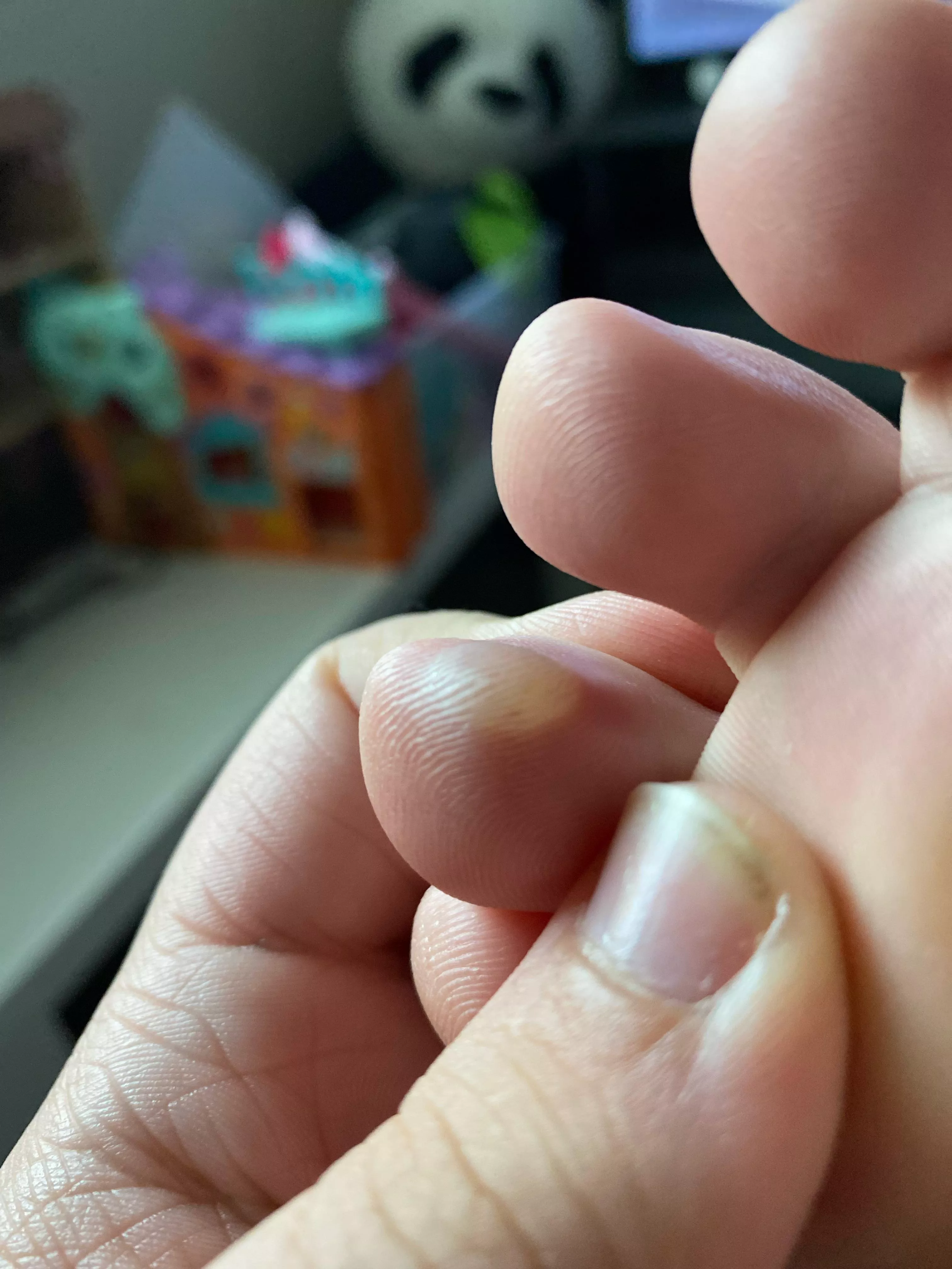Big blister on my toe