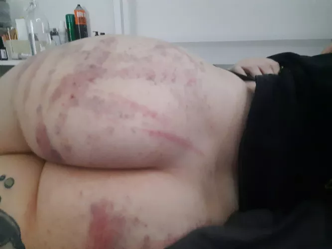 (OC) Happiness is an exceptionally bruised ass