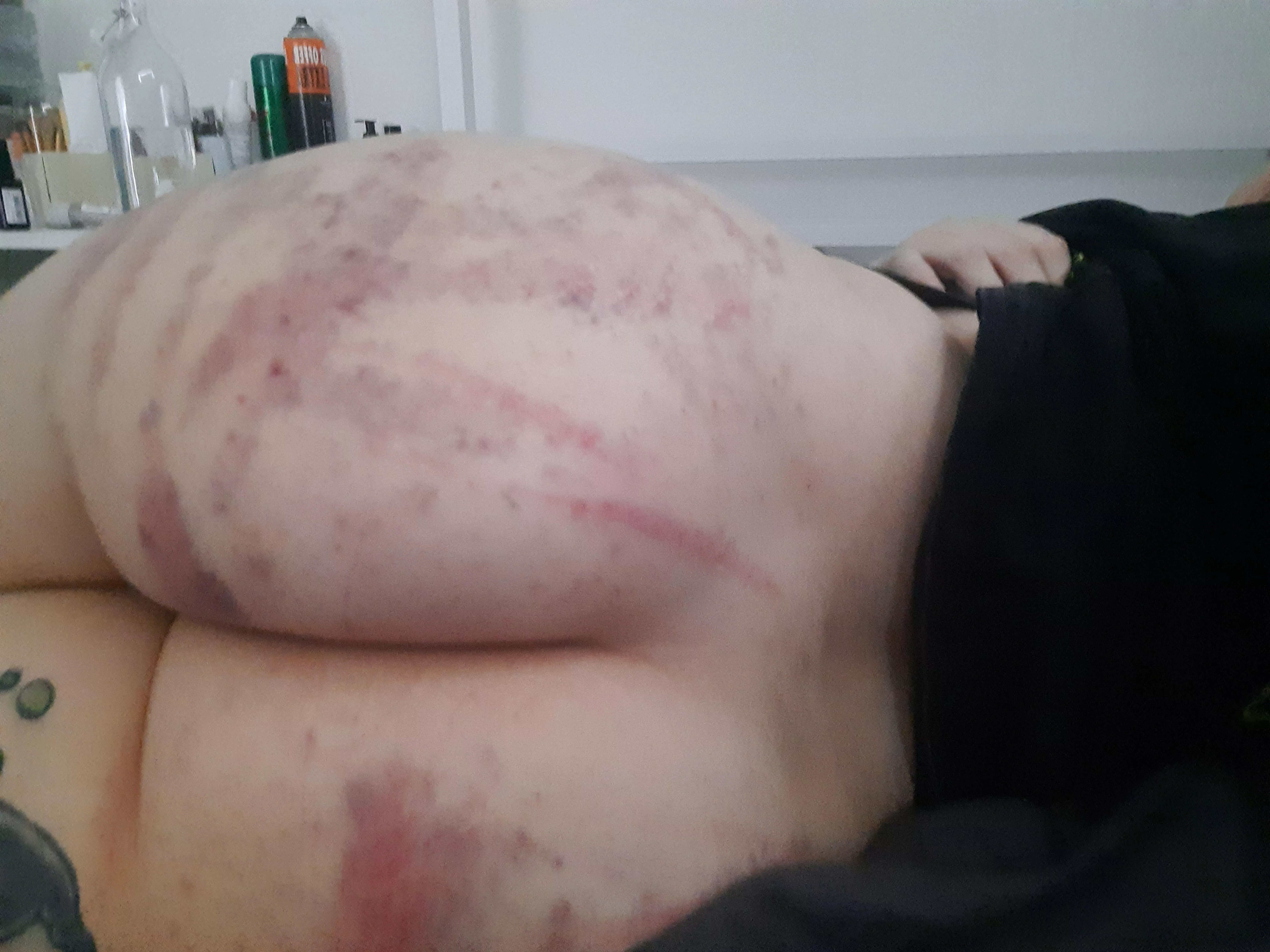 (OC) Happiness is an exceptionally bruised ass