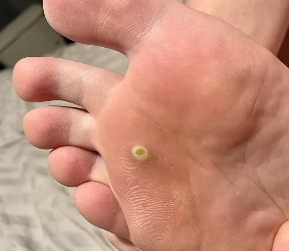 What is this and will it eventually pop? Feels a little squishy in the middle, sensitive to walk on, had it a few days to a week.