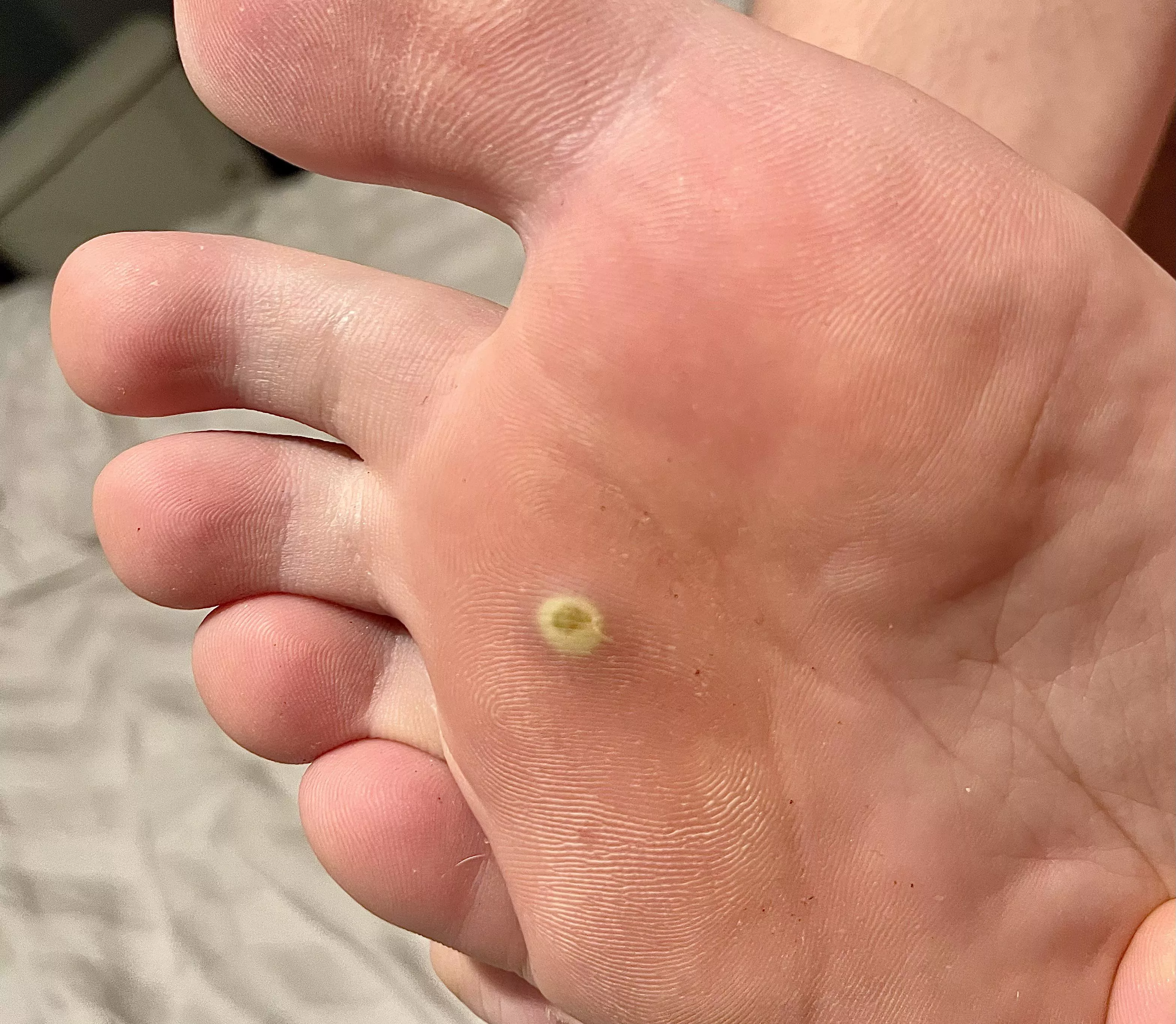 What is this and will it eventually pop? Feels a little squishy in the middle, sensitive to walk on, had it a few days to a week.