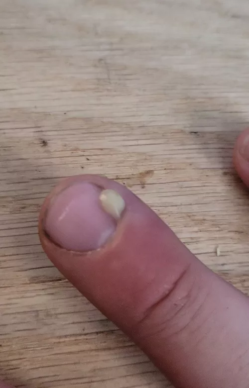 Finger is somehow infected. Finally was able to pop it.