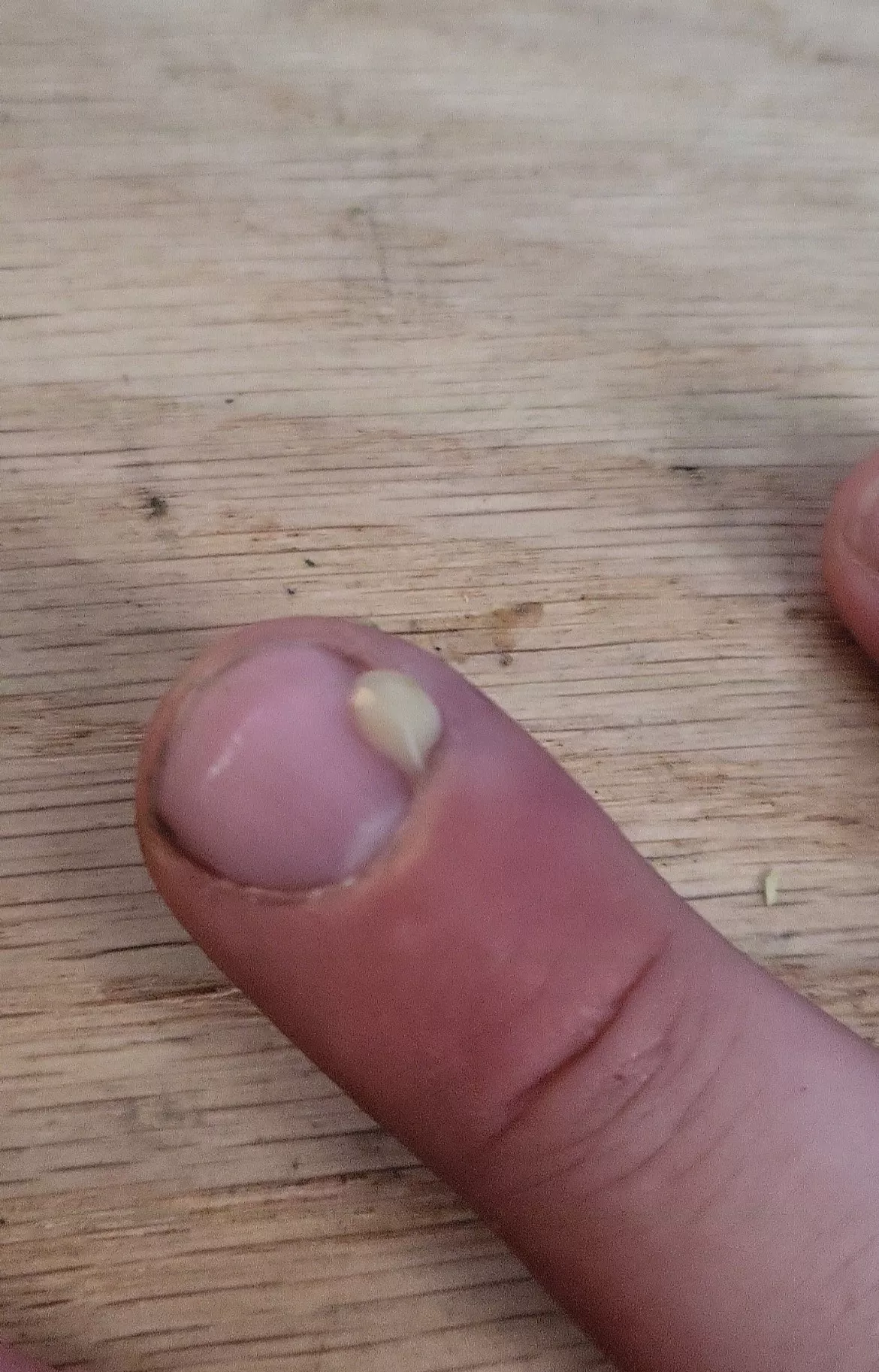 Finger is somehow infected. Finally was able to pop it.