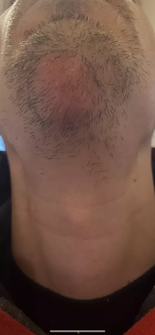 Got this brewing up on my throat, due in surgery tomorrow, can I request they film it?