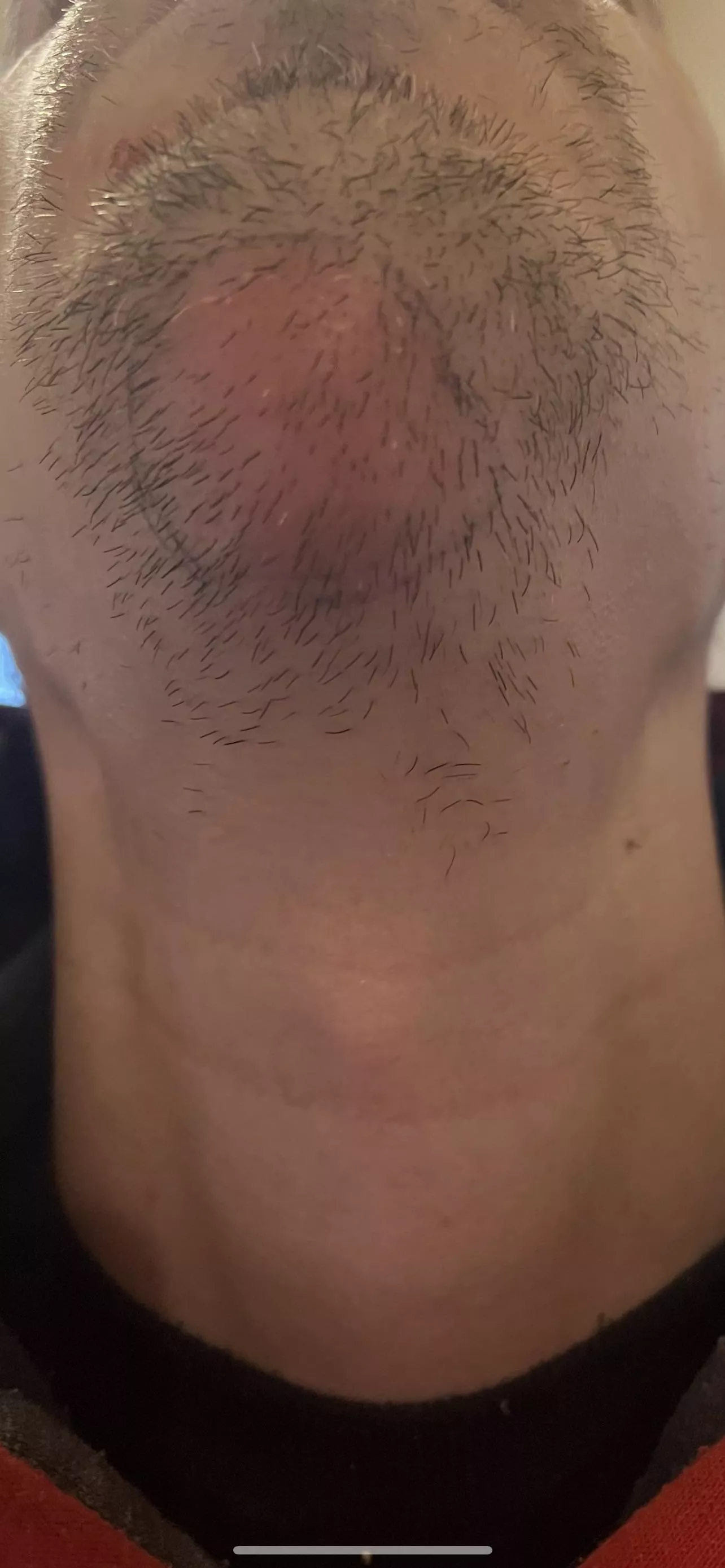 Got this brewing up on my throat, due in surgery tomorrow, can I request they film it?