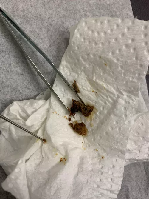 My first post. I didn’t have the courage to ask to film the extraction. The other ear had a bigger plug that was removed!