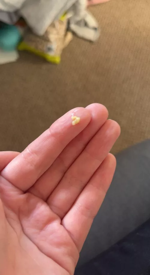 Tonsil Stones keep getting bigger, i’ve done everything :((