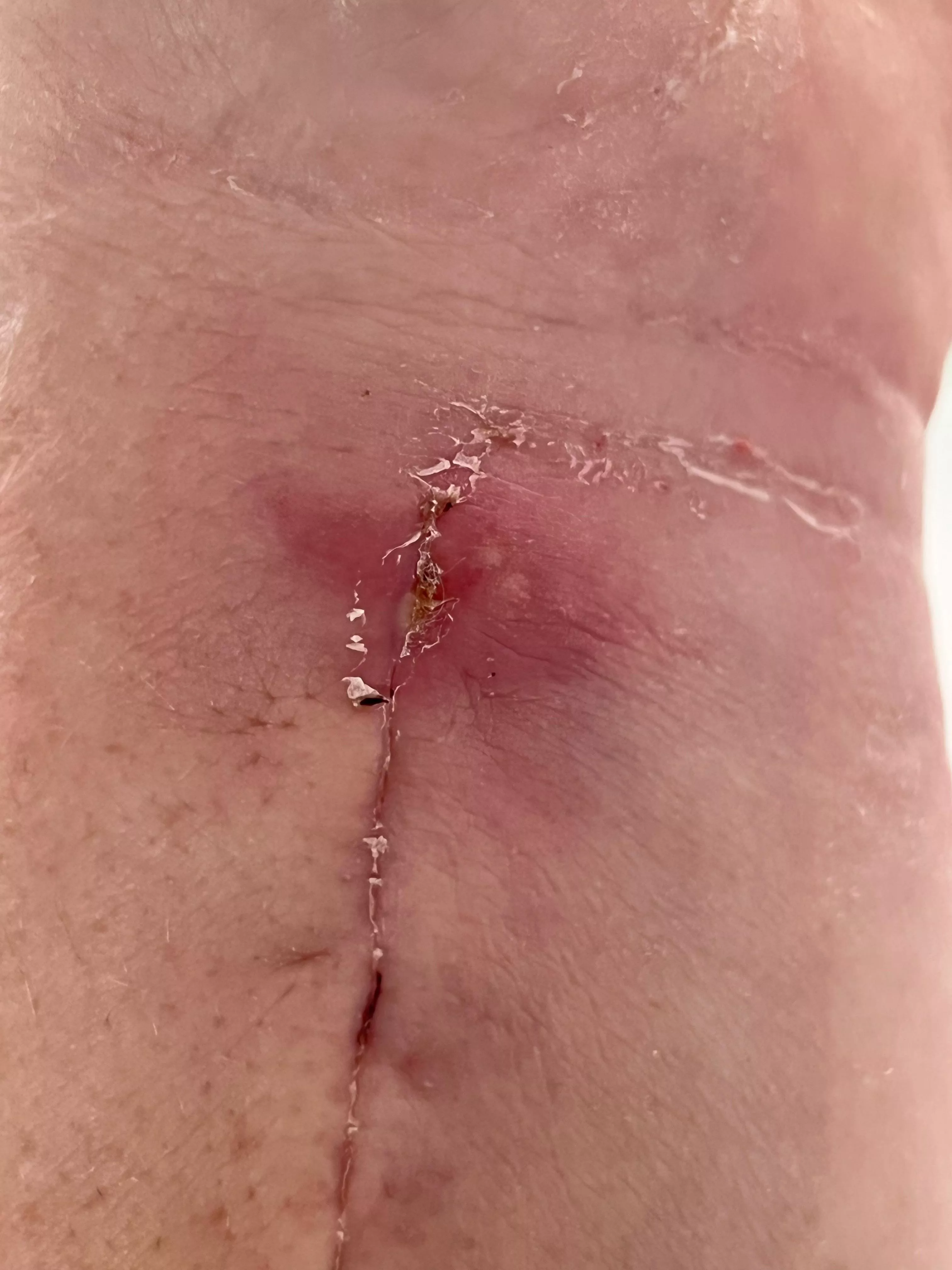 Forbidden pop after surgery to plate my broken wrist. There’s a head!!!