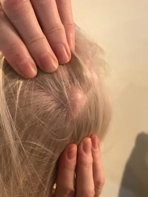 my mums head cyst, I will film the removal when it happens. I can't wait!!