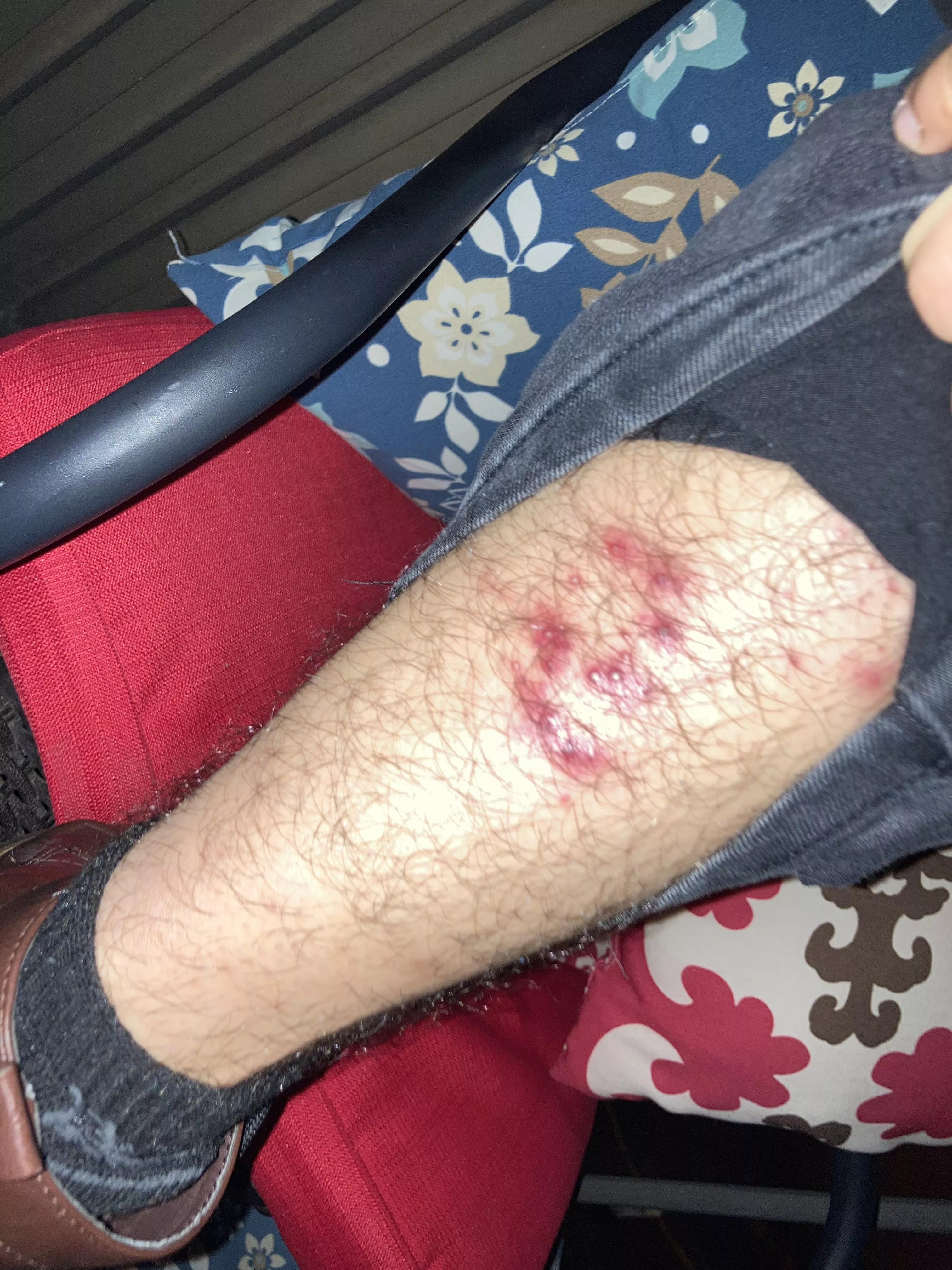 Big patch of pimples appeared suddenly. Could it be monkeypox?