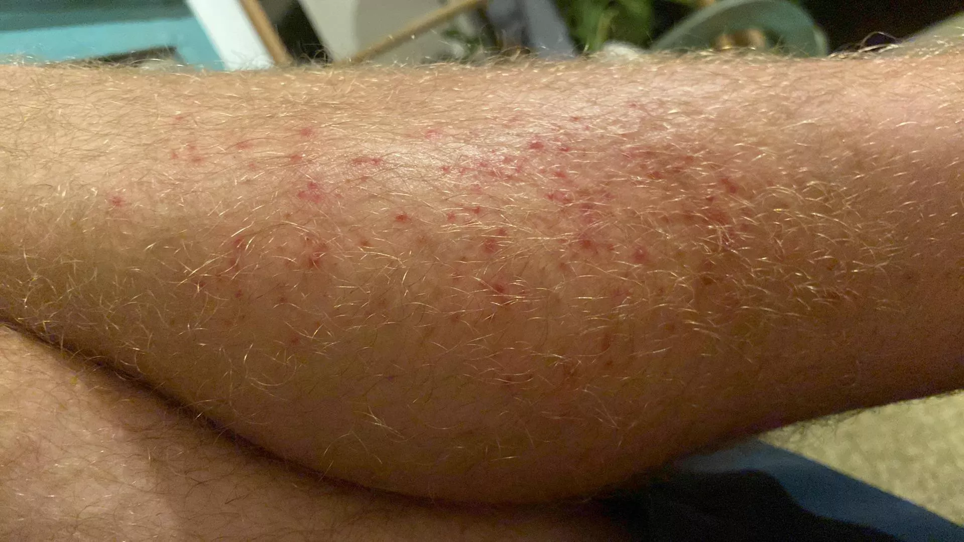Forbidden pops or not? Folliculitis from a massage.