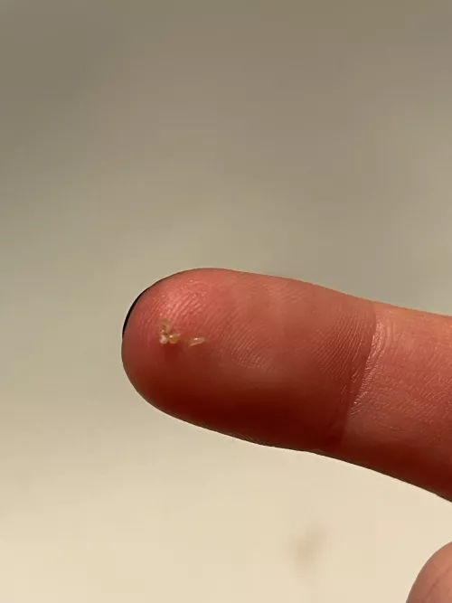 Thought it was a mega blackhead. Was actually just four in a very close cluster.