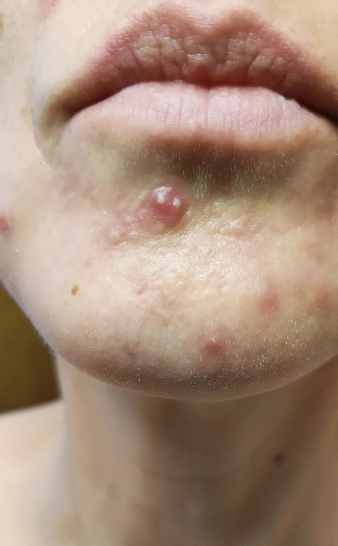 I've been waiting this one out, think I'm gonna give it a few more hours.