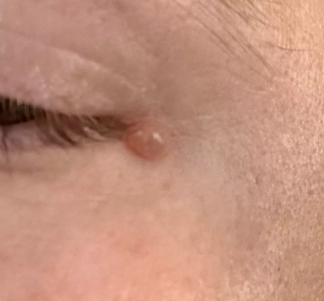 I’ve had this guy for like a decade now. Should I lance it?