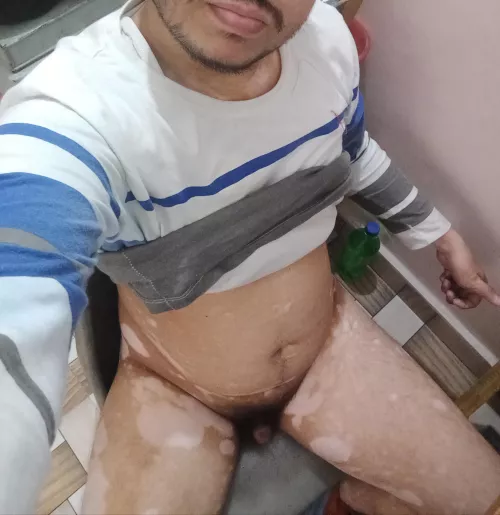 I have a skin disorder called vitiligo