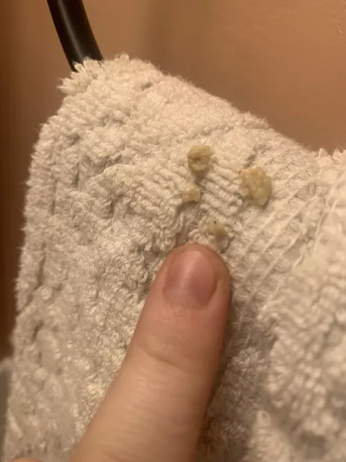 Finally got these tonsil stones! I’m amazed and disgusted