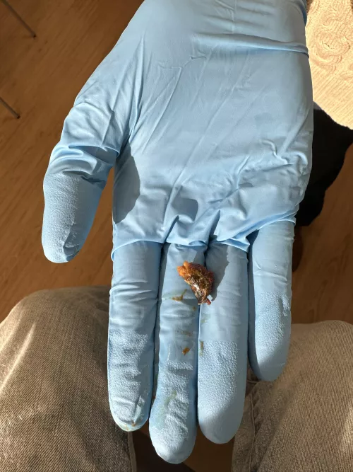 Got this little sucker out after two visits and days of ear drops… now time to work on the other ear😳