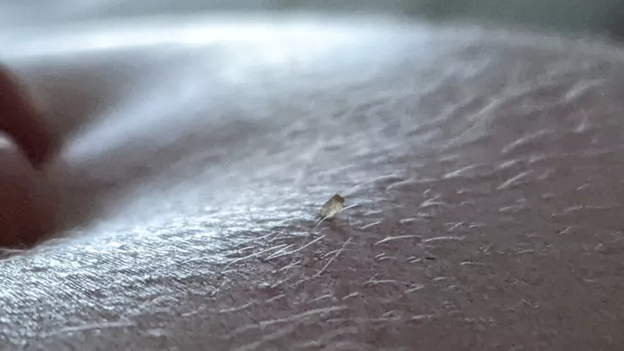 Little blackhead on back