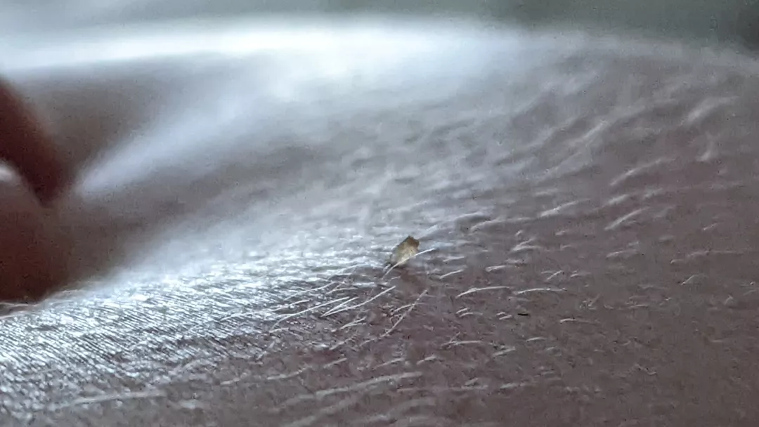 Little blackhead on back