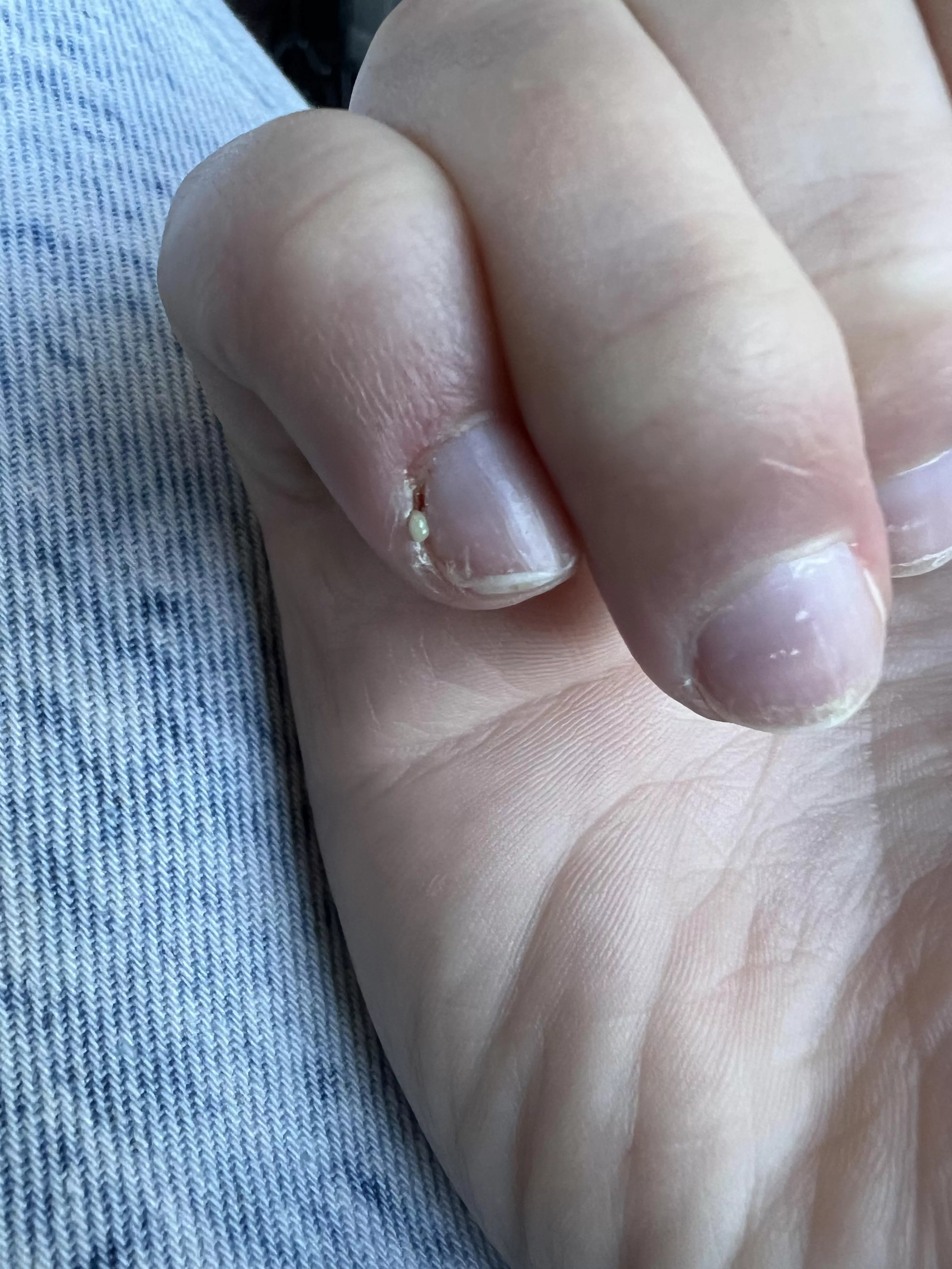 (OC) Highly unexpected pop, I knew my pinkie felt hot and hurt, but this came out almost in slow-mo (sorry for dry hands)