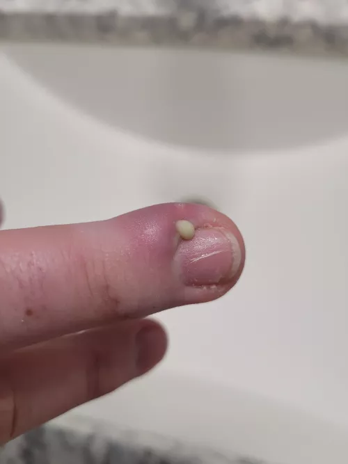 There she blows! A satisfying followup to my paranychia.