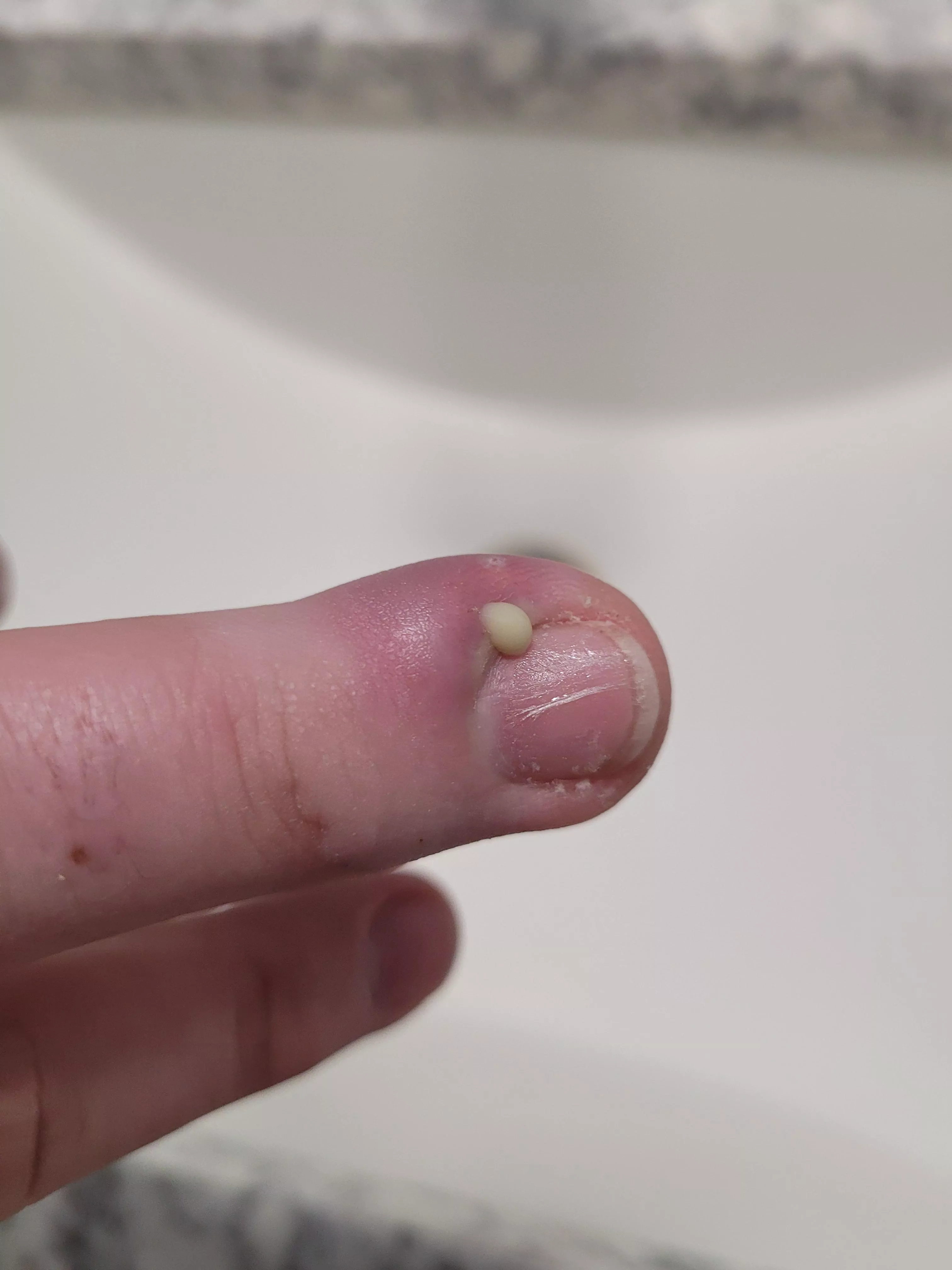 There she blows! A satisfying followup to my paranychia.