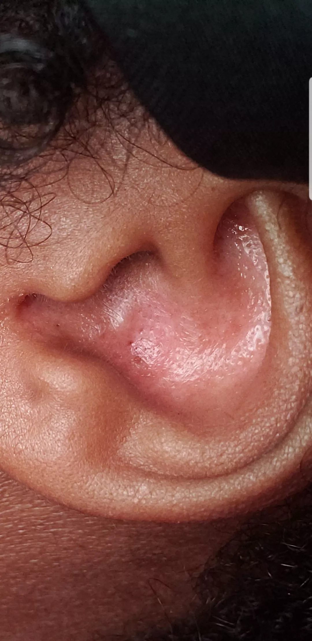 sigh. I wish I had someone to pop these blackheads out of my ear. I just dealt with an ingrown on my private area the other day