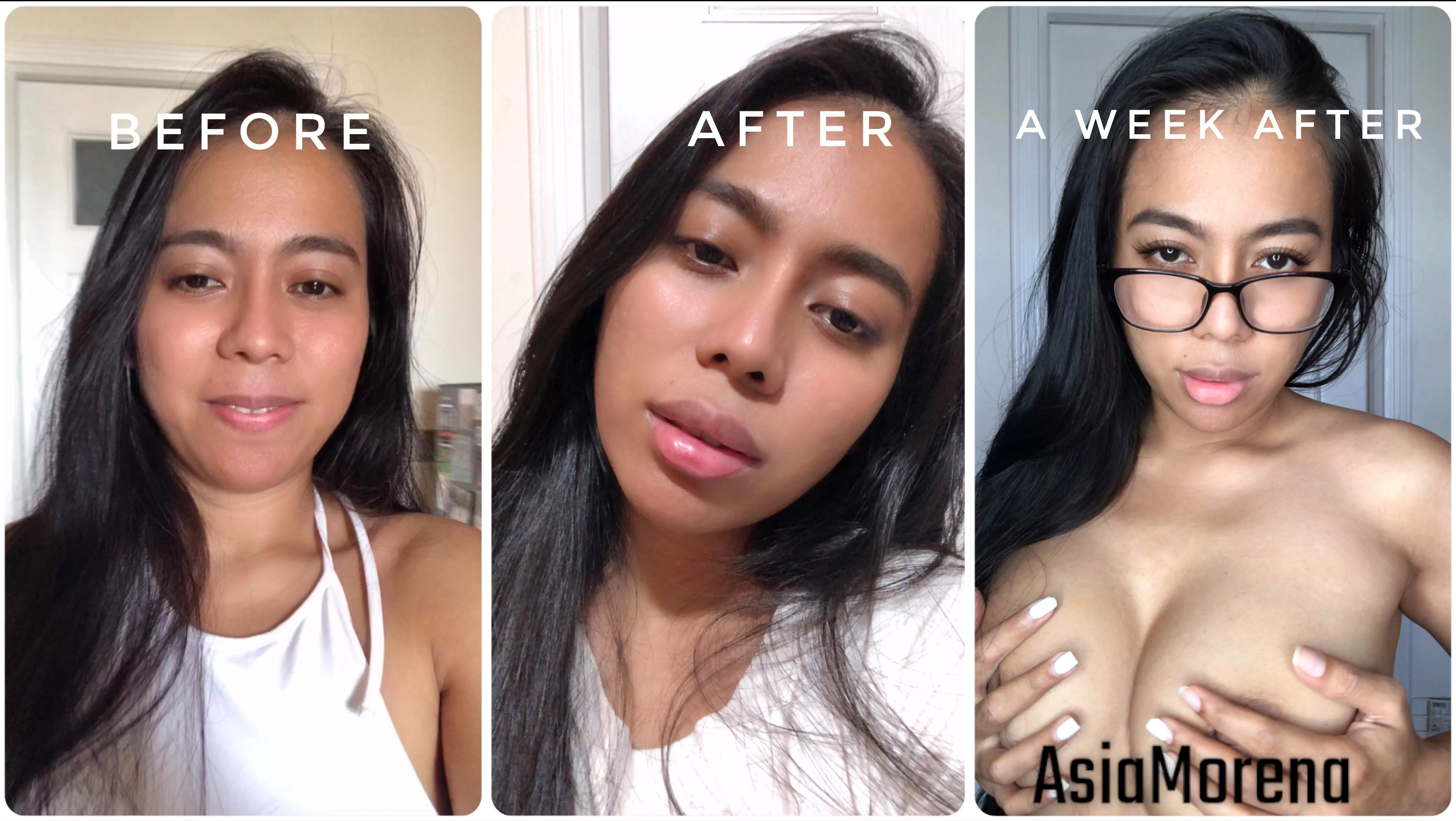 Back when I had my first ever lip filler at the beginning of this year! I’d love to have plumper, juicier bimbo cockpillow lips 👄