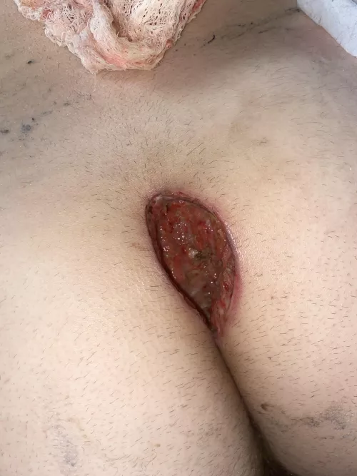My Brother’s butt after pilonidal cyst surgery (he gave permission)