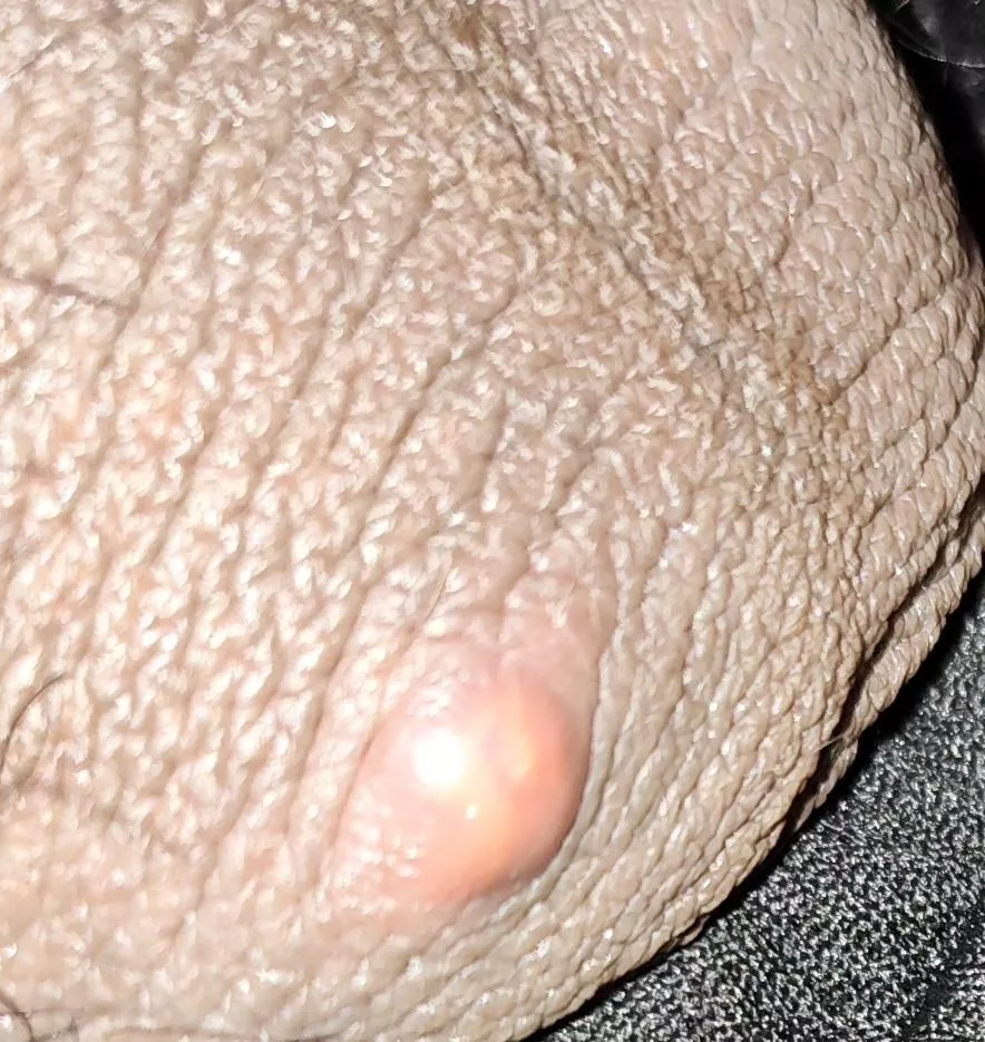 Is this a cyst or just a pimple? It just grow yesterday and it hurts to touch. This is on my scrotum.