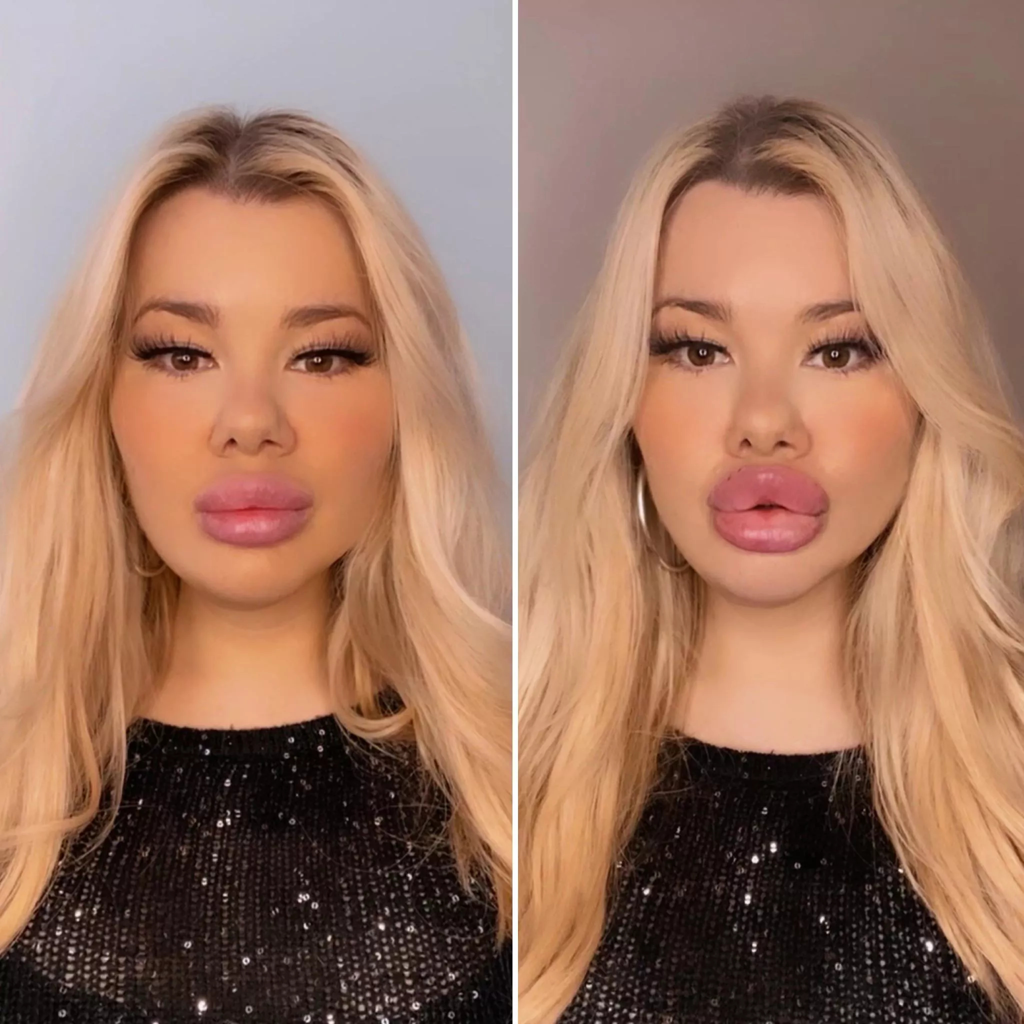 Lips keep filling 🤤💉💋