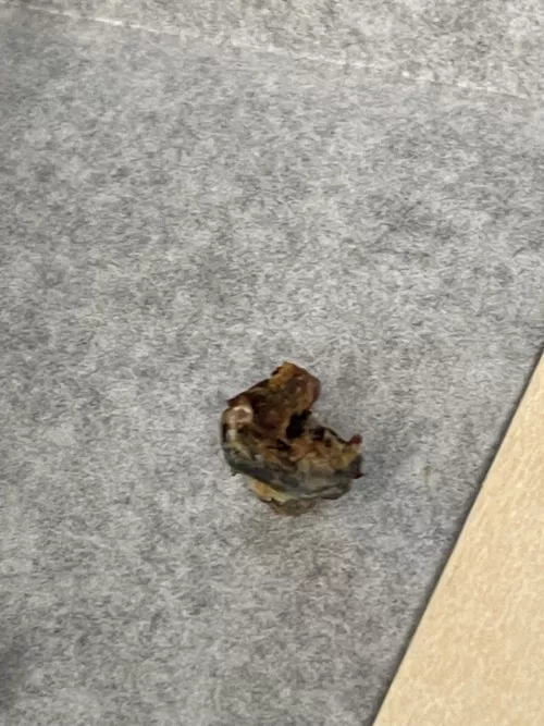 They tell you not to use Q Tips.. ENT Sucked this out and I feel like I hear everything now lol