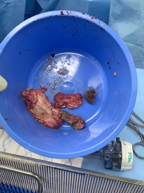 Ovarian Dermoid Cyst- I had a laparoscopic right ovarian cystectomy done yesterday to remove a 10 cm dermoid cyst. Along with hair I believe there was also a tooth in it because we saw one on the ct scan. Luckily my right ovary was left in tact and I am 