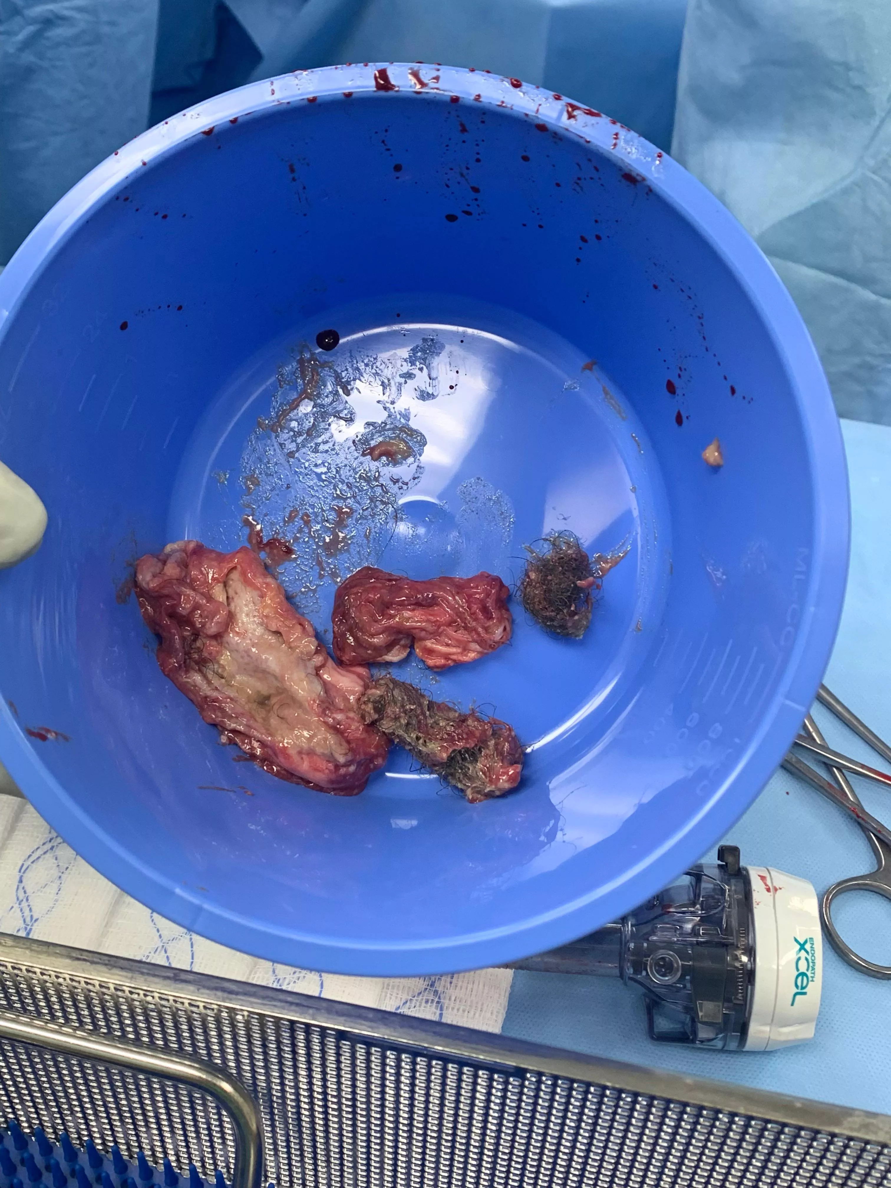Ovarian Dermoid Cyst- I had a laparoscopic right ovarian cystectomy done yesterday to remove a 10 cm dermoid cyst. Along with hair I believe there was also a tooth in it because we saw one on the ct scan. Luckily my right ovary was left in tact and I am  Ovarian Dermoid Cyst- I had a laparoscopic right ovarian cystectomy done yesterday to remove a 10 cm dermoid cyst. Along with hair I believe there was also a tooth in it because we saw one on the ct scan. Luckily my right ovary was left in tact and I am
